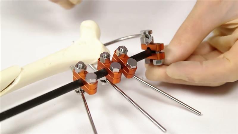 A Quick Clinical Guide to Reducing Pin Loosening in External Skeletal Fixation